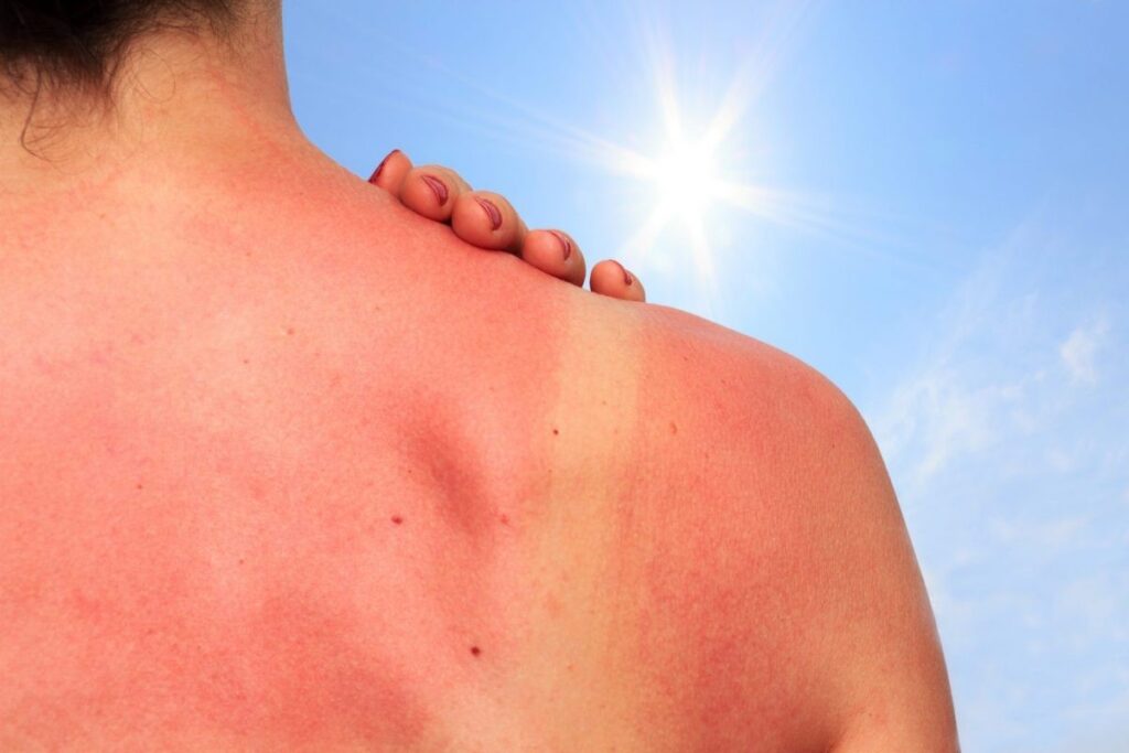 sun damage to skin - sun awareness week 2020 